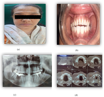 (a,b) Pre-Operative Clinical Photograph and (c,d) Radiograph, OPG and Ct Scan (axial section)