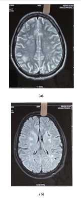 MRI: (a) Axial T2 - multifocal discrete areas of hyperintensities noted in bilateral fronto parietal sub cortical white matter and centrum semi ovale (b) axial T2 flair hyper intensities noted in bilateral gangliocapsular region and left occipital subcortical white matter with few areas of gliosis