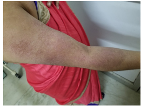 Showing Violaceous Erythematous Papules Over the Right