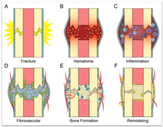 stages of fracture healing
