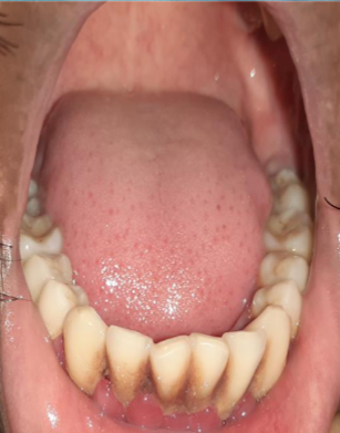Red Inflamed Gingiva