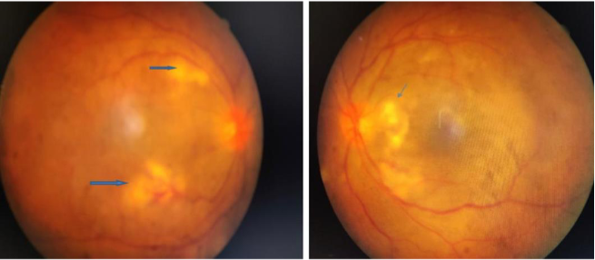 Fundus picture of both eyes showing multiple yellowish white areas of retinal inflammation with macular edema.