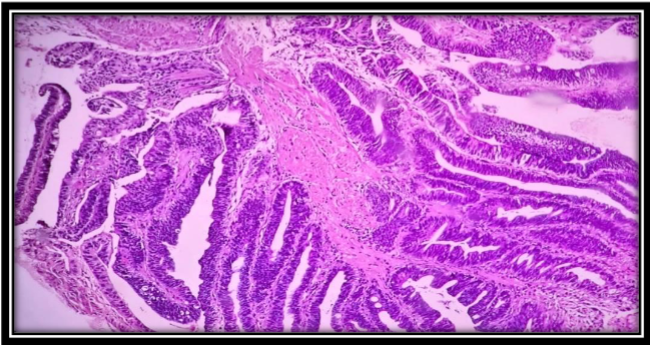 Photomicrograph of well differentiated Adenocarcinoma (H&E, x100)
